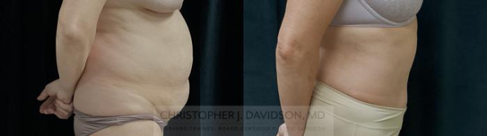Tummy Tuck (Abdominoplasty) Case 310 Before & After Right Side | Boston, MA | Christopher J. Davidson, MD