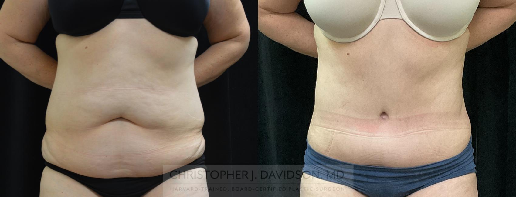 Tummy Tuck (Abdominoplasty) Case 311 Before & After Front | Boston, MA | Christopher J. Davidson, MD