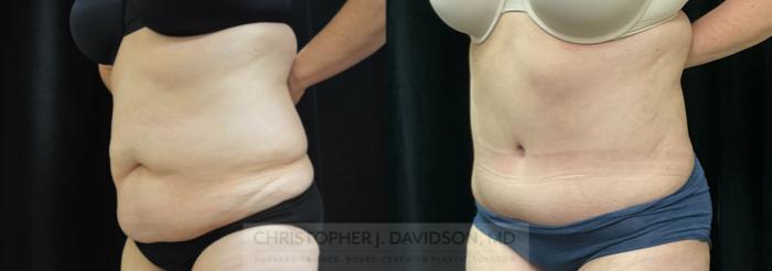 Tummy Tuck (Abdominoplasty) Case 311 Before & After Left Oblique | Boston, MA | Christopher J. Davidson, MD
