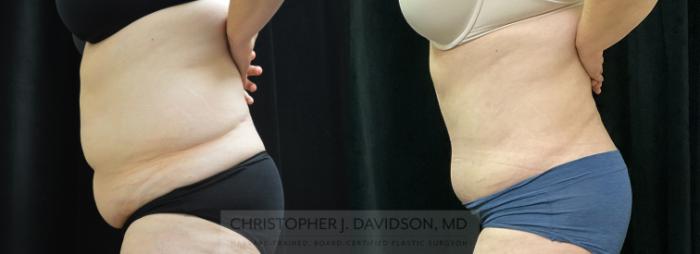Tummy Tuck (Abdominoplasty) Case 311 Before & After Left Side | Boston, MA | Christopher J. Davidson, MD