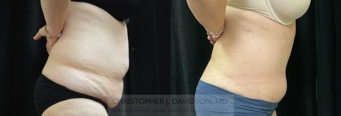 Tummy Tuck (Abdominoplasty) Case 311 Before & After Right Side | Boston, MA | Christopher J. Davidson, MD