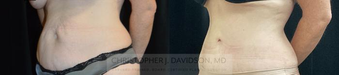 Liposuction Case 328 Before & After Left Oblique | Boston, MA | Christopher J. Davidson, MD
