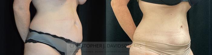 Tummy Tuck (Abdominoplasty) Case 328 Before & After Right Oblique | Boston, MA | Christopher J. Davidson, MD
