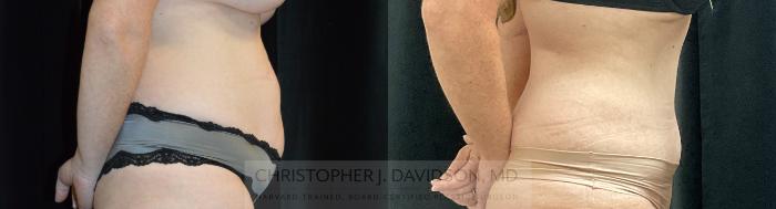 Tummy Tuck (Abdominoplasty) Case 328 Before & After Right Side | Boston, MA | Christopher J. Davidson, MD