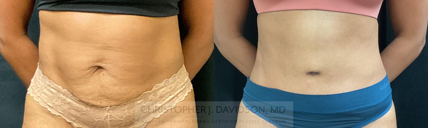 Tummy Tuck (Abdominoplasty) Case 339 Before & After Front | Boston, MA | Christopher J. Davidson, MD