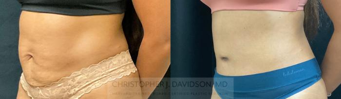 Tummy Tuck (Abdominoplasty) Case 339 Before & After Left Oblique | Boston, MA | Christopher J. Davidson, MD