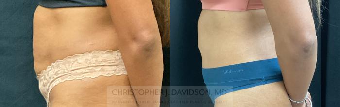 Tummy Tuck (Abdominoplasty) Case 339 Before & After Left Side | Boston, MA | Christopher J. Davidson, MD