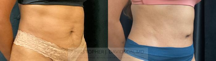 Tummy Tuck (Abdominoplasty) Case 339 Before & After Right Oblique | Boston, MA | Christopher J. Davidson, MD
