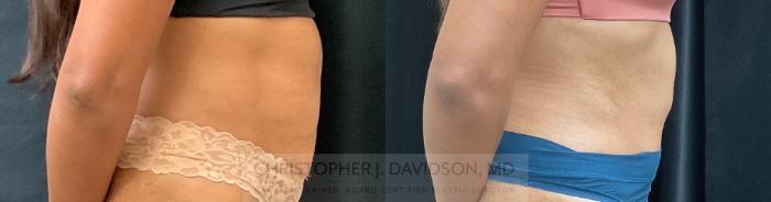 Tummy Tuck (Abdominoplasty) Case 339 Before & After Right Side | Boston, MA | Christopher J. Davidson, MD