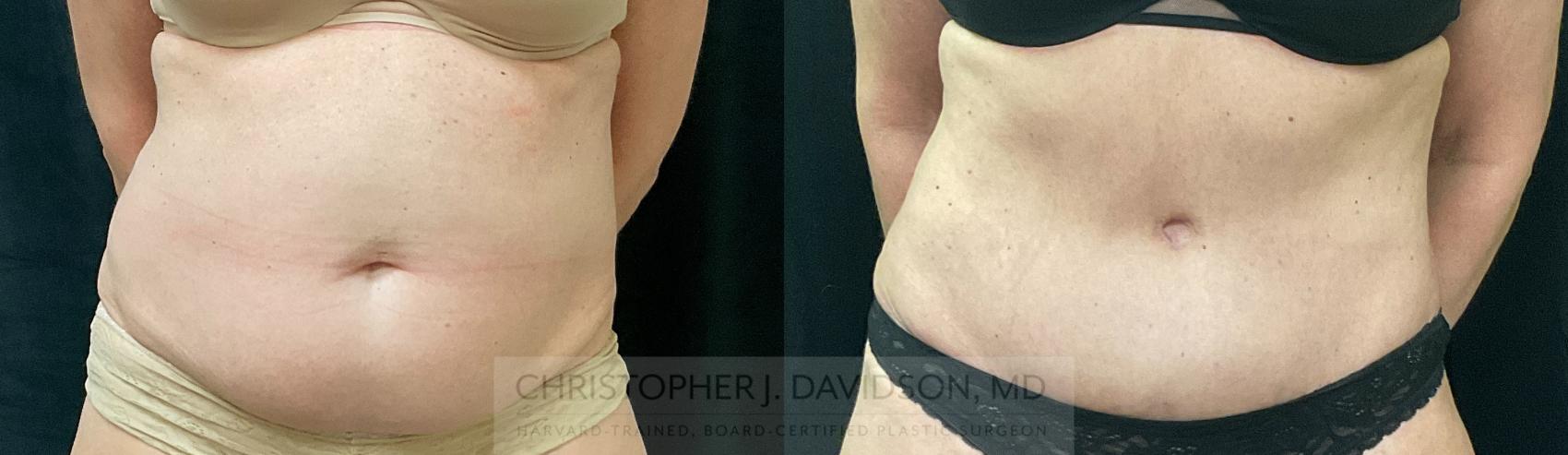Tummy Tuck (Abdominoplasty) Case 342 Before & After Front | Boston, MA | Christopher J. Davidson, MD