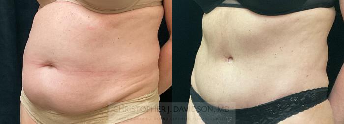 Tummy Tuck (Abdominoplasty) Case 342 Before & After Left Oblique | Boston, MA | Christopher J. Davidson, MD