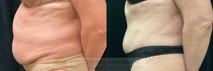 Tummy Tuck (Abdominoplasty) Case 342 Before & After Left Side | Boston, MA | Christopher J. Davidson, MD