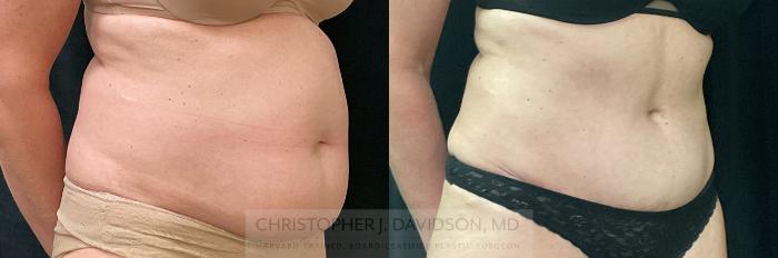 Tummy Tuck (Abdominoplasty) Case 342 Before & After Right Oblique | Boston, MA | Christopher J. Davidson, MD