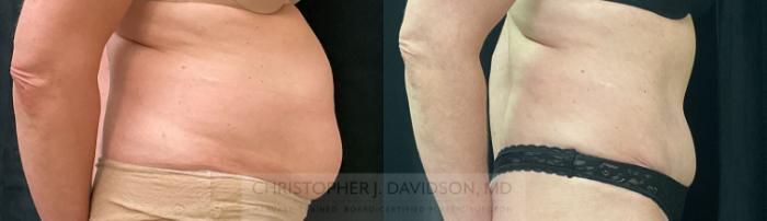 Tummy Tuck (Abdominoplasty) Case 342 Before & After Right Side | Boston, MA | Christopher J. Davidson, MD