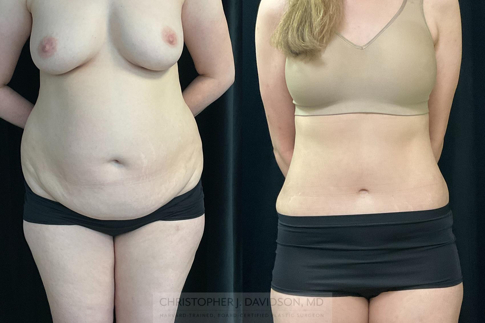 Tummy Tuck (Abdominoplasty) Case 351 Before & After Front | Boston, MA | Christopher J. Davidson, MD