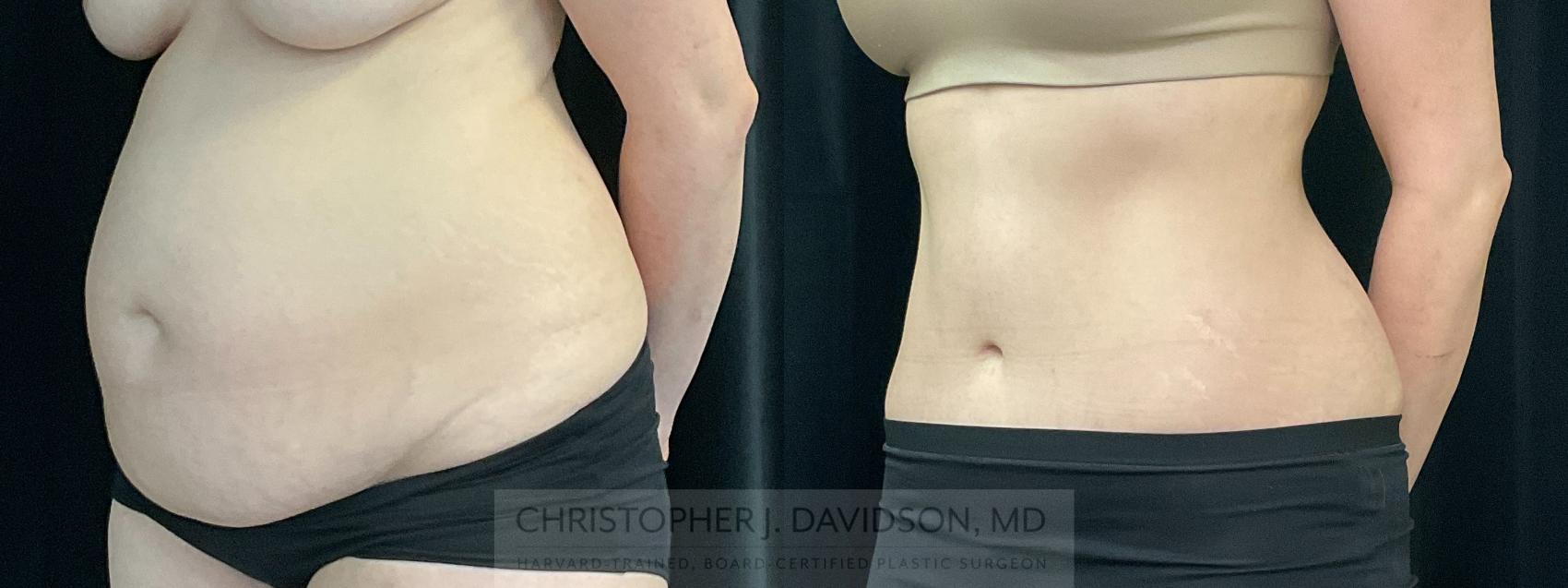 Tummy Tuck (Abdominoplasty) Case 351 Before & After Left Oblique | Boston, MA | Christopher J. Davidson, MD