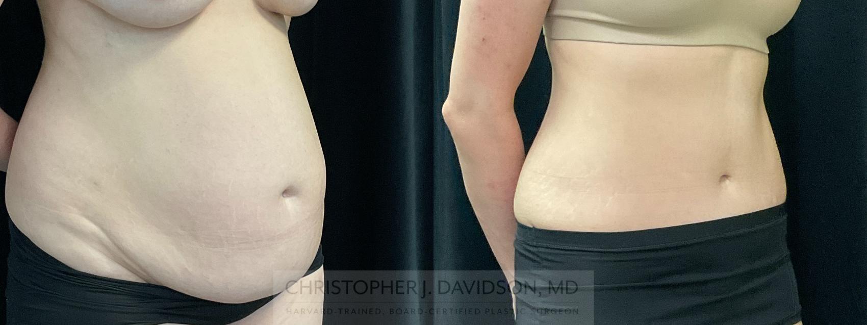 Tummy Tuck (Abdominoplasty) Case 351 Before & After Right Oblique | Boston, MA | Christopher J. Davidson, MD