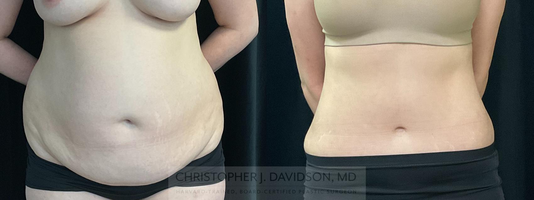 Tummy Tuck (Abdominoplasty) Case 352 Before & After Front | Boston, MA | Christopher J. Davidson, MD
