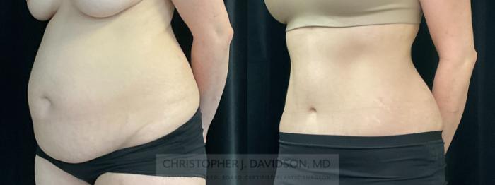 Tummy Tuck (Abdominoplasty) Case 352 Before & After Left Oblique | Boston, MA | Christopher J. Davidson, MD
