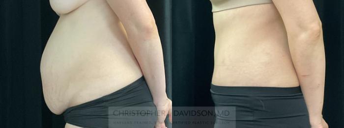Tummy Tuck (Abdominoplasty) Case 352 Before & After Left Side | Boston, MA | Christopher J. Davidson, MD