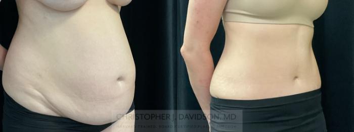 Tummy Tuck (Abdominoplasty) Case 352 Before & After Right Oblique | Boston, MA | Christopher J. Davidson, MD
