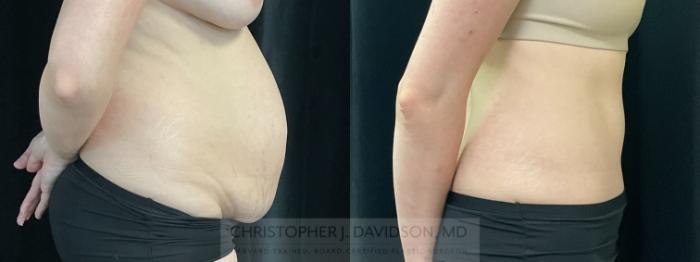 Tummy Tuck (Abdominoplasty) Case 352 Before & After Right Side | Boston, MA | Christopher J. Davidson, MD