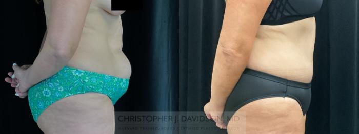 Tummy Tuck (Abdominoplasty) Case 353 Before & After Right Side | Boston, MA | Christopher J. Davidson, MD