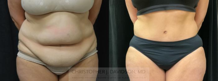 Tummy Tuck (Abdominoplasty) Case 354 Before & After Front | Boston, MA | Christopher J. Davidson, MD