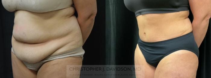 Tummy Tuck (Abdominoplasty) Case 354 Before & After Left Oblique | Boston, MA | Christopher J. Davidson, MD