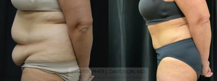 Tummy Tuck (Abdominoplasty) Case 354 Before & After Left Side | Boston, MA | Christopher J. Davidson, MD