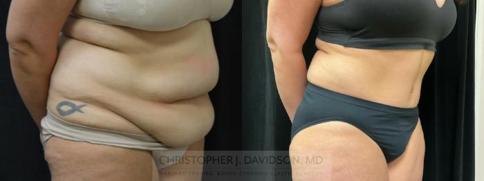 Tummy Tuck (Abdominoplasty) Case 354 Before & After Right Oblique | Boston, MA | Christopher J. Davidson, MD
