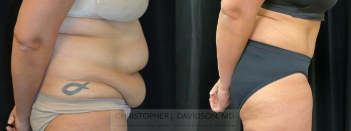 Tummy Tuck (Abdominoplasty) Case 354 Before & After Right Side | Boston, MA | Christopher J. Davidson, MD