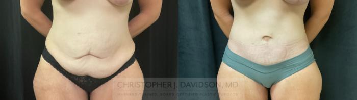 Tummy Tuck (Abdominoplasty) Case 360 Before & After Front | Boston, MA | Christopher J. Davidson, MD