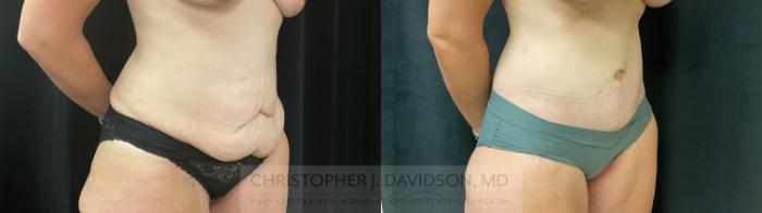 Tummy Tuck (Abdominoplasty) Case 360 Before & After Right Oblique | Boston, MA | Christopher J. Davidson, MD