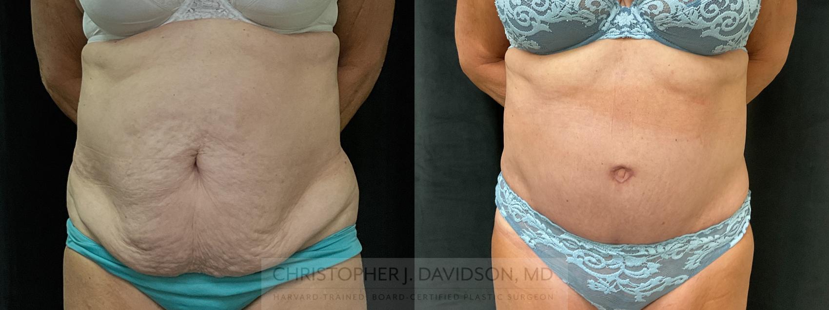 Tummy Tuck (Abdominoplasty) Case 366 Before & After Front | Boston, MA | Christopher J. Davidson, MD