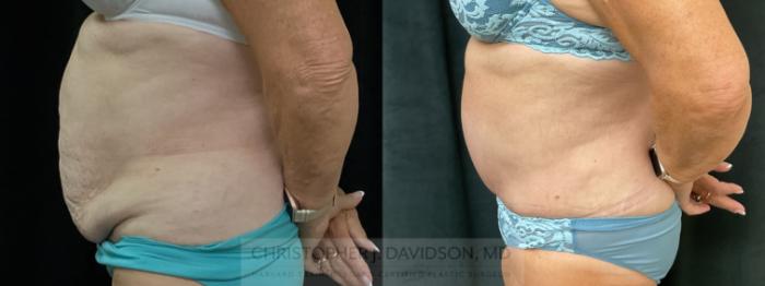 Tummy Tuck (Abdominoplasty) Case 366 Before & After Left Side | Boston, MA | Christopher J. Davidson, MD