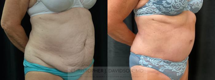 Tummy Tuck (Abdominoplasty) Case 366 Before & After Right Oblique | Boston, MA | Christopher J. Davidson, MD