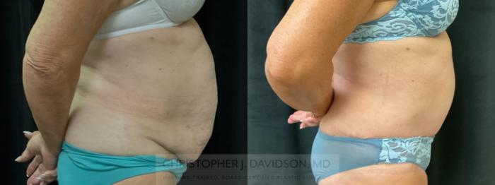 Tummy Tuck (Abdominoplasty) Case 366 Before & After Right Side | Boston, MA | Christopher J. Davidson, MD