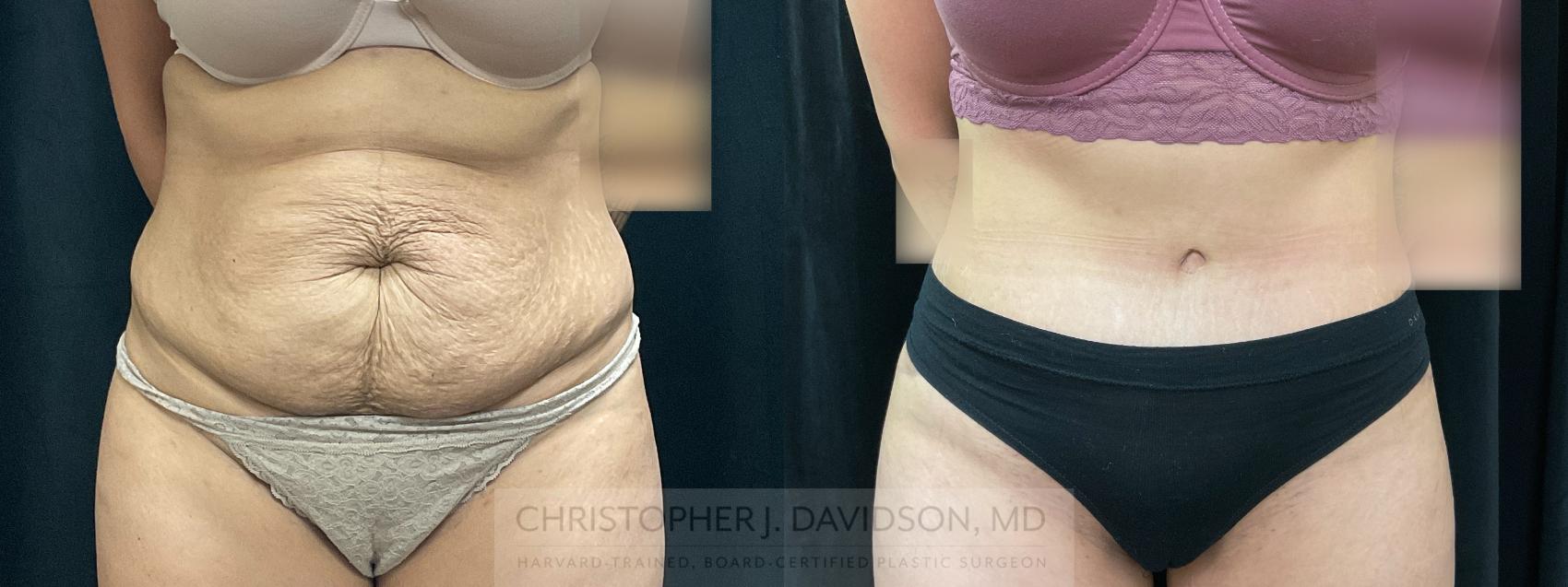 Tummy Tuck (Abdominoplasty) Case 367 Before & After Front | Boston, MA | Christopher J. Davidson, MD