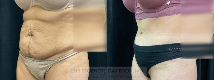 Tummy Tuck (Abdominoplasty) Case 367 Before & After Left Oblique | Boston, MA | Christopher J. Davidson, MD