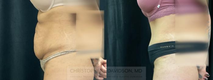 Tummy Tuck (Abdominoplasty) Case 367 Before & After Left Side | Boston, MA | Christopher J. Davidson, MD