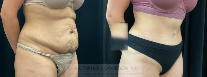 Tummy Tuck (Abdominoplasty) Case 367 Before & After Right Oblique | Boston, MA | Christopher J. Davidson, MD