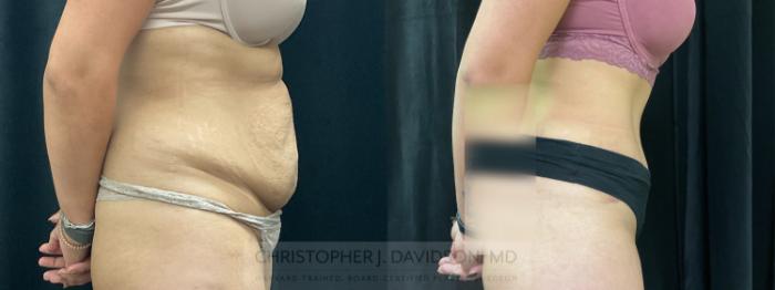 Tummy Tuck (Abdominoplasty) Case 367 Before & After Right Side | Boston, MA | Christopher J. Davidson, MD