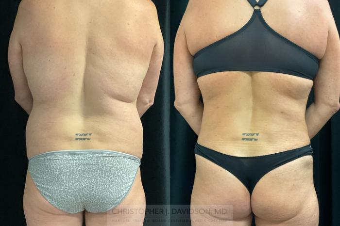 Tummy Tuck (Abdominoplasty) Case 374 Before & After Back | Boston, MA | Christopher J. Davidson, MD