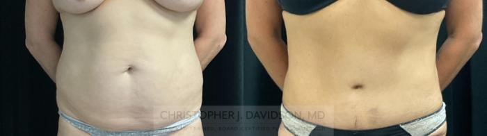 Tummy Tuck (Abdominoplasty) Case 374 Before & After Front | Boston, MA | Christopher J. Davidson, MD