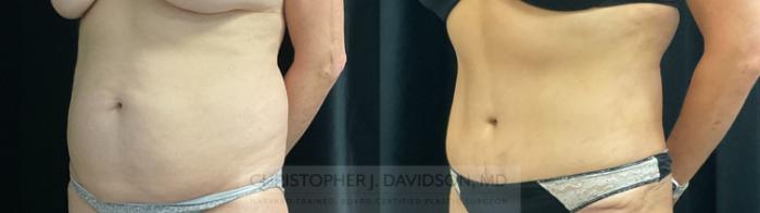 Tummy Tuck (Abdominoplasty) Case 374 Before & After Left Oblique | Boston, MA | Christopher J. Davidson, MD