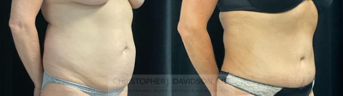 Tummy Tuck (Abdominoplasty) Case 374 Before & After Right Oblique | Boston, MA | Christopher J. Davidson, MD