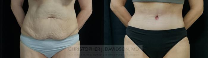 Tummy Tuck (Abdominoplasty) Case 388 Before & After Front | Boston, MA | Christopher J. Davidson, MD