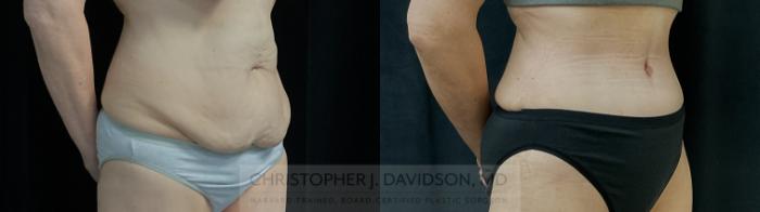 Tummy Tuck (Abdominoplasty) Case 388 Before & After Right Oblique | Boston, MA | Christopher J. Davidson, MD