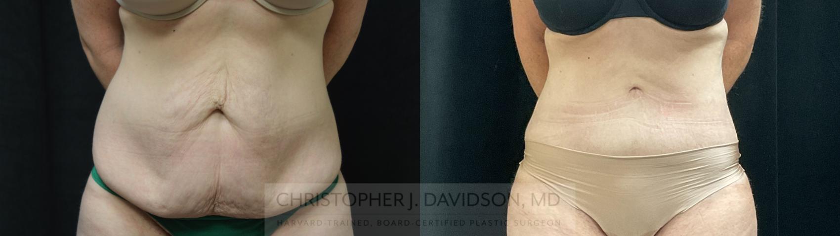 Tummy Tuck (Abdominoplasty) Case 389 Before & After Front | Boston, MA | Christopher J. Davidson, MD